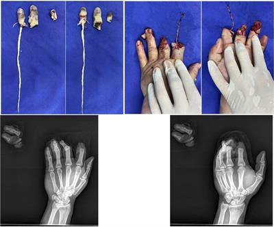 Transplantation of a free fillet flap from discarded fingers for repair of a finger pulp skin defect: a case report